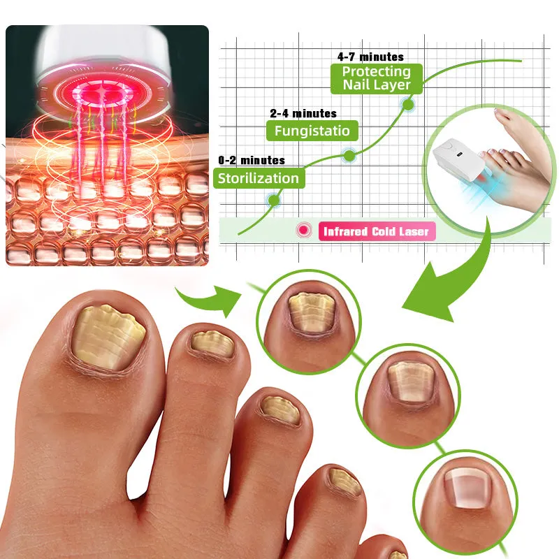 Furzero™ Nail Fungus Laser Therapy Device 🍀