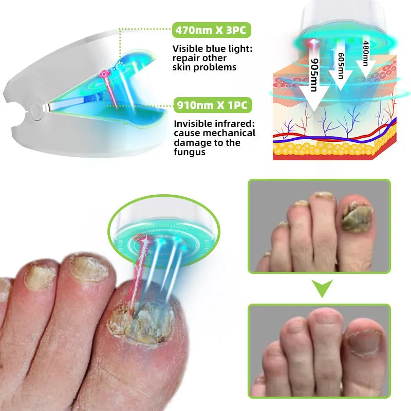Furzero™ Nail Fungus Laser Therapy Device 🍀