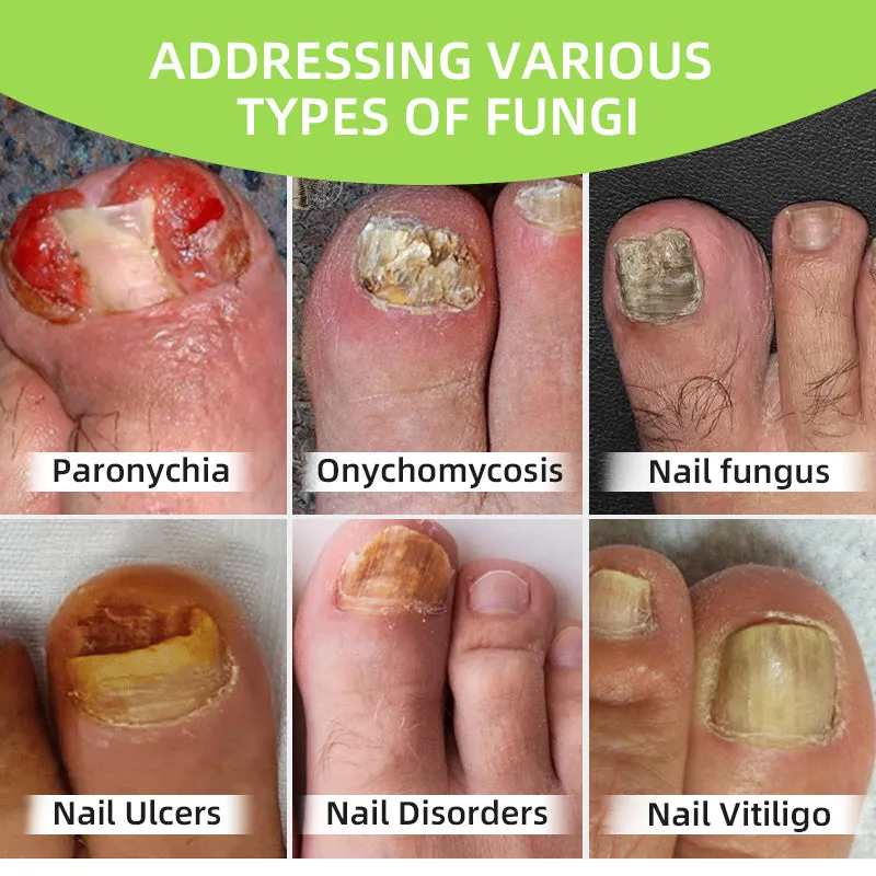 Furzero™ Nail Fungus Laser Therapy Device 🍀