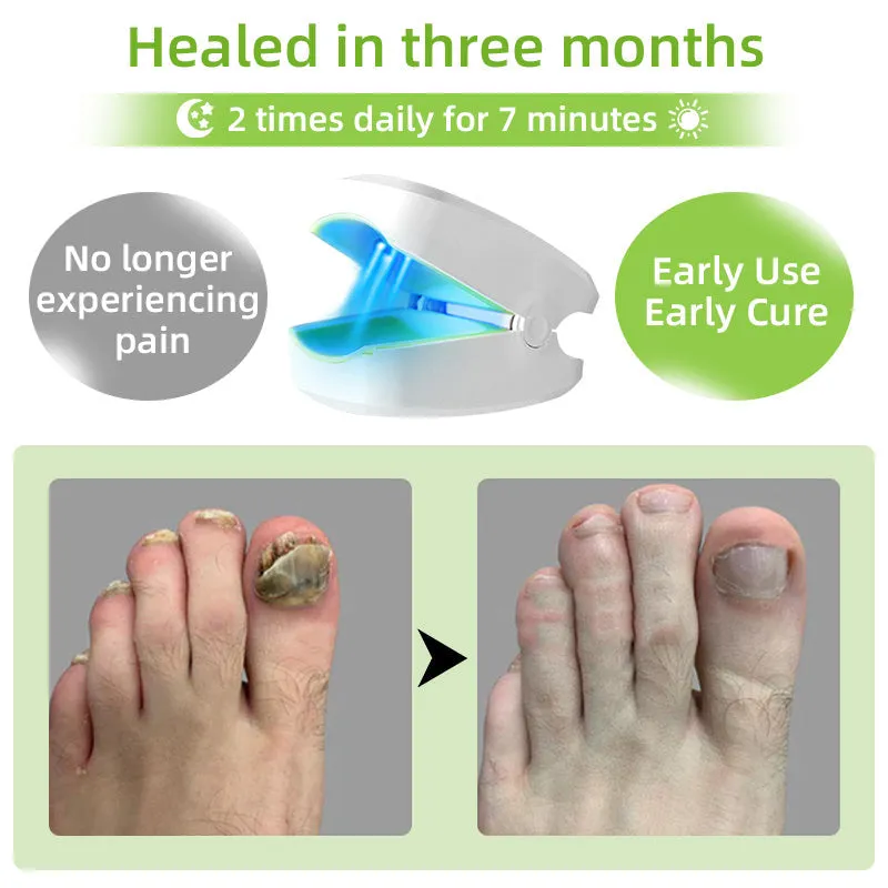 Furzero™ Nail Fungus Laser Therapy Device 🍀